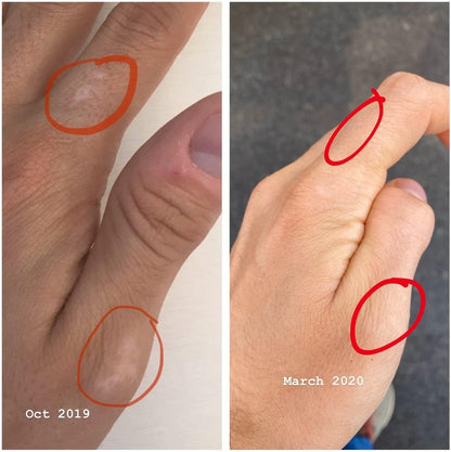 Recouleur Vitiligo Vitamin and Mineral Supplement for Normal Skin Pigmentation - 6 Month Supply