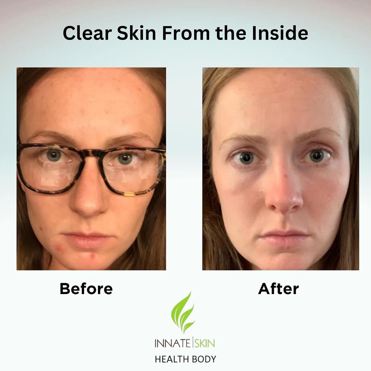 Clear Skin Acne Vitamin System - 60 Capsules (2-Pack) - görsel 3
