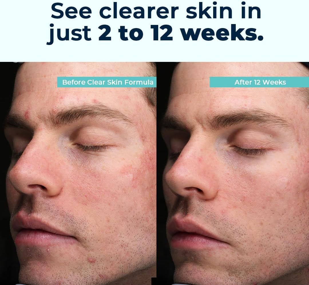 VitaMedica Clear Skin Vitamin Formula – Non-Cystic Acne Supplement for Skin Clearing - görsel 4