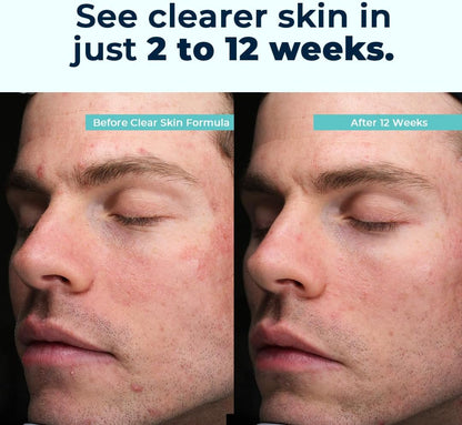 VitaMedica Clear Skin Vitamin Formula | Non-cystic Acne Supplement for Skin Clearing | 2 Pack