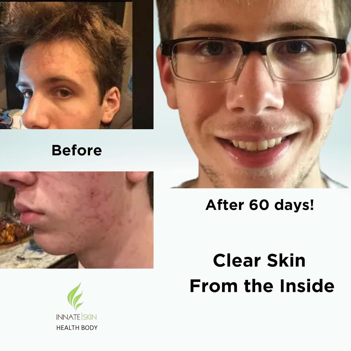 Clear Skin Acne Vitamin System - 240 Capsules (4 Pack) - görsel 3