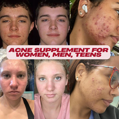 Acnetame Acne Pills – Vitamin Supplement for Clear Skin – 60 Tablets